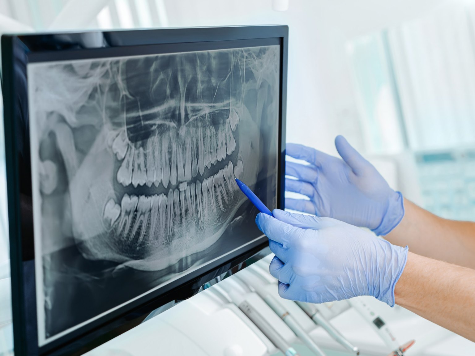 Gloved hands pointing to the wisdom teeth on a panoramic x-ray