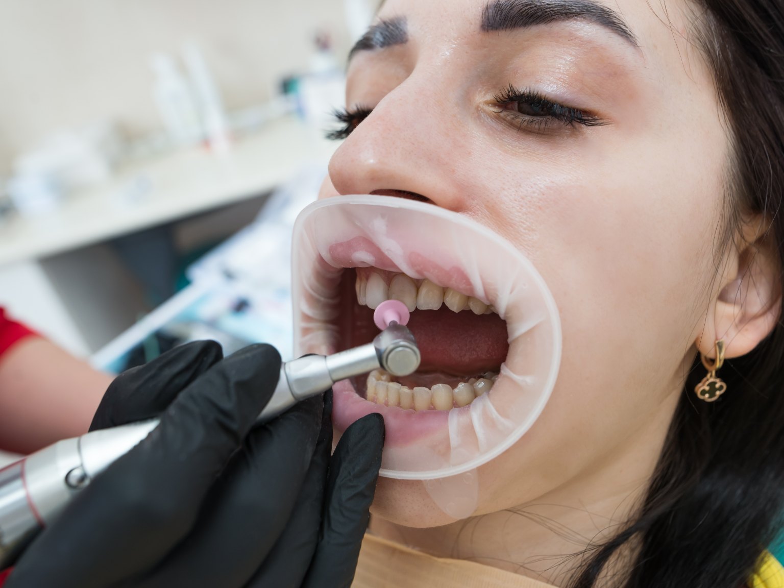A patient with a cheek retractor in place while a gloved dentist works on her front teeth