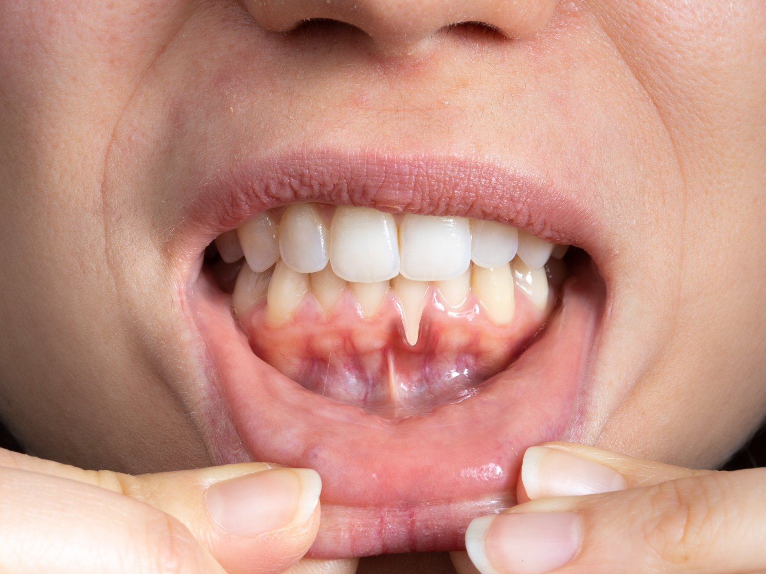Lower lip held down to show gum pulled back from a lower front tooth, its root exposed