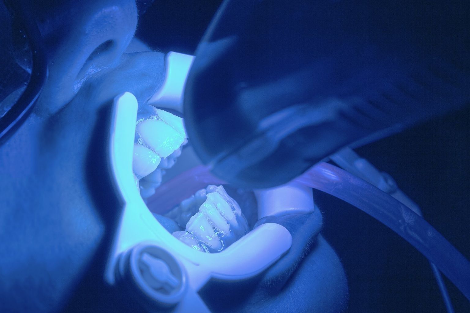 A blue curing light in the mouth
