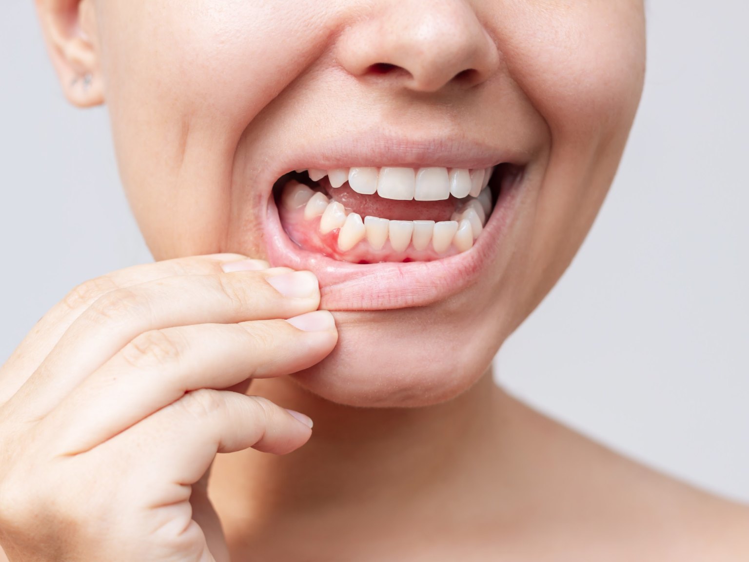 A woman pulling down her lower lip to show a sore, red patch of gum
