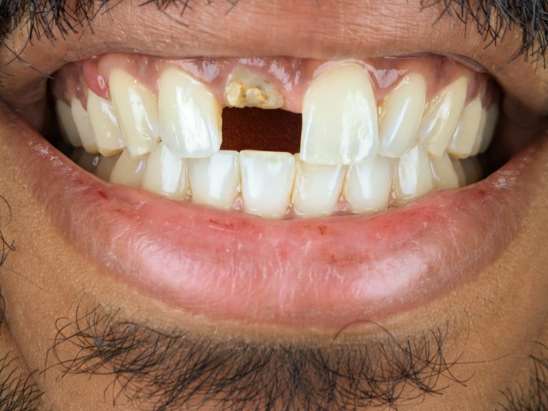 A man's smile with a gap where an upper front tooth is missing