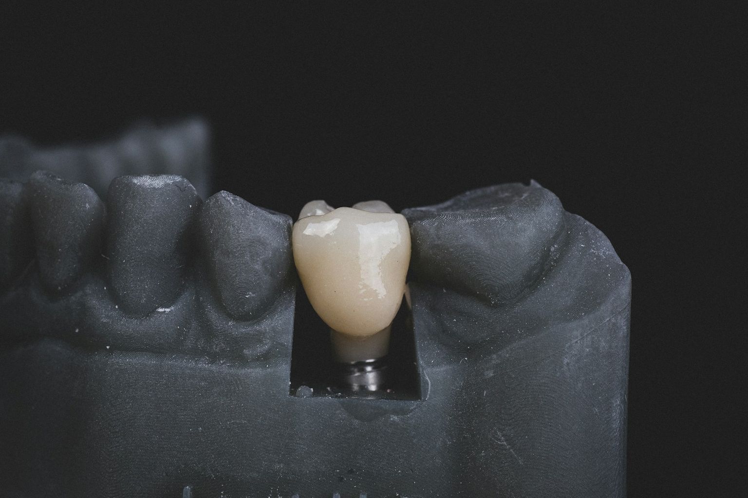 A ceramic crown seated on a dental model