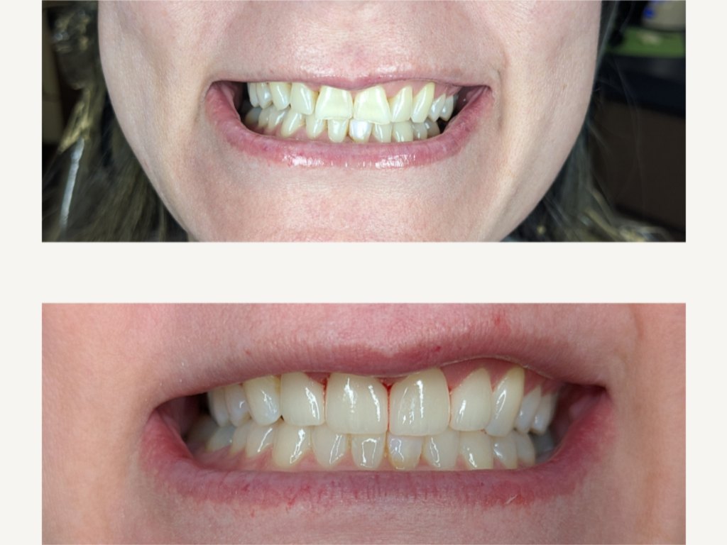 A patient's smile before and after cosmetic treatment, stacked one above the other