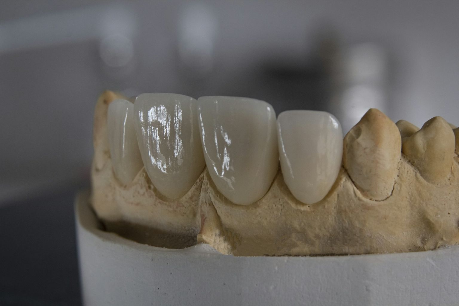 Crowns on a plaster cast, before fitting
