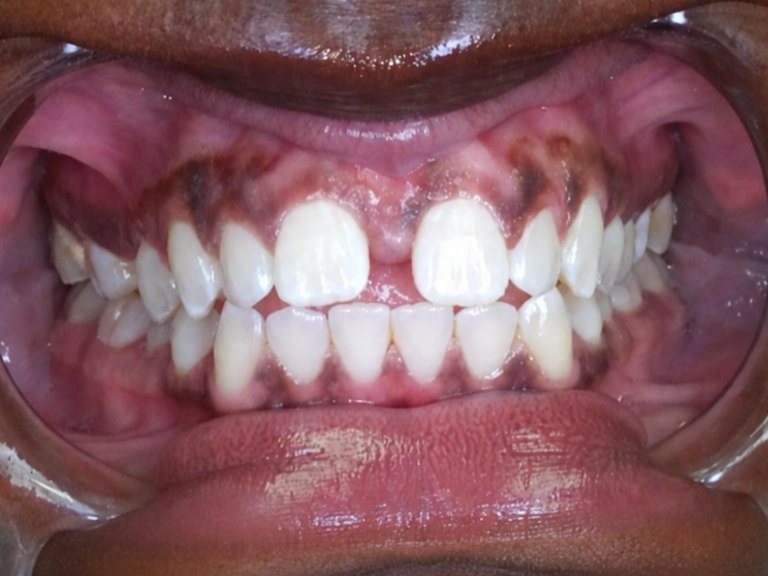 A close-up of a small gap between the two upper front teeth