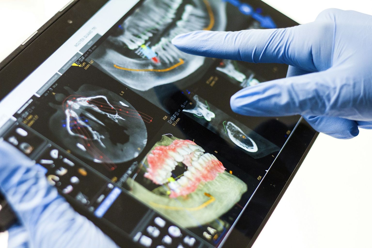 A gloved hand pointing at a 3D scan of the jaw on a tablet