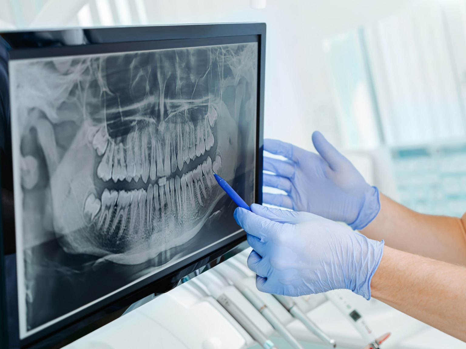 Gloved hands pointing a pen at a tooth on a panoramic dental x-ray