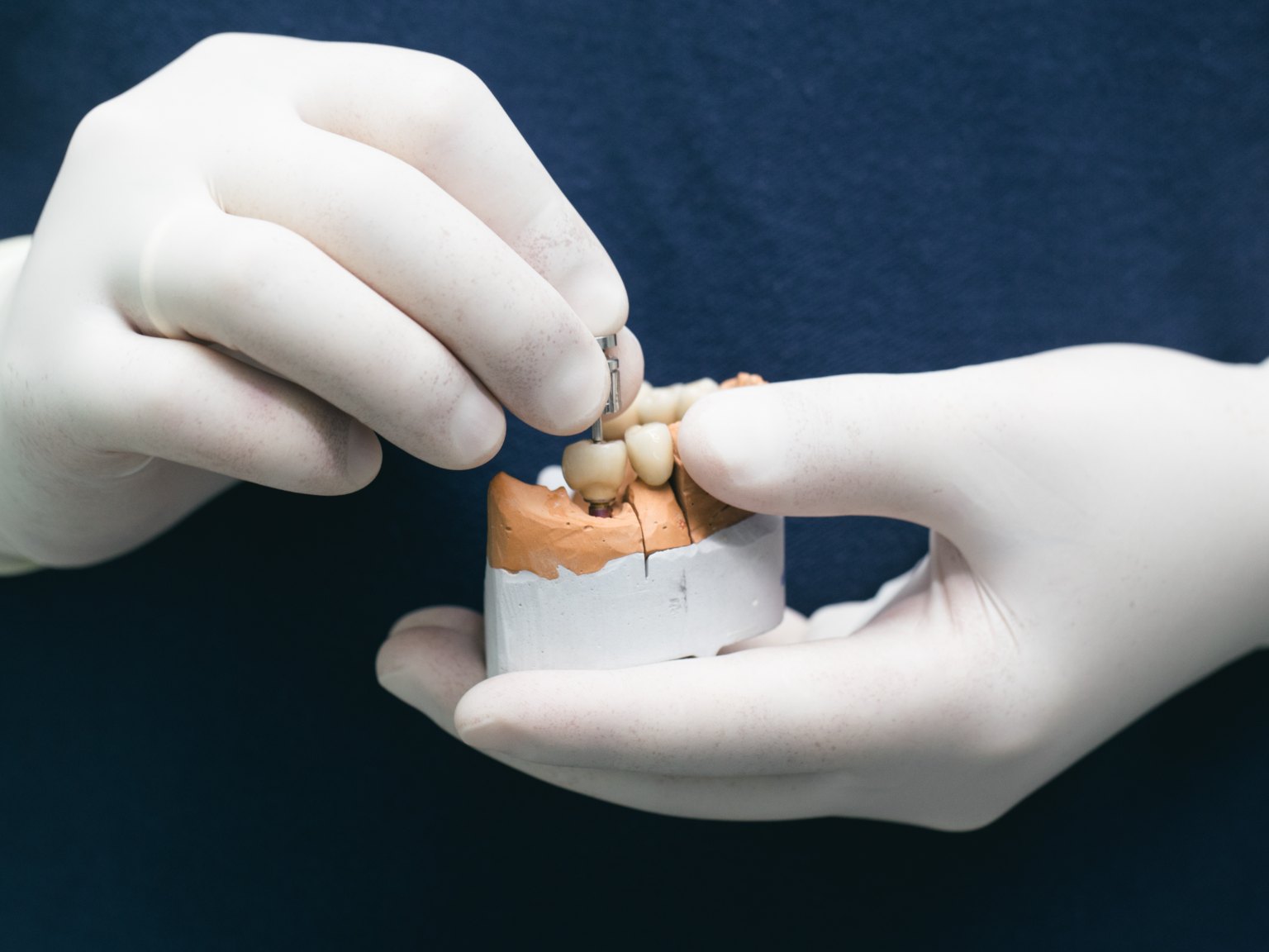 Gloved hands screwing a multi-tooth bridge onto implants in a stone model