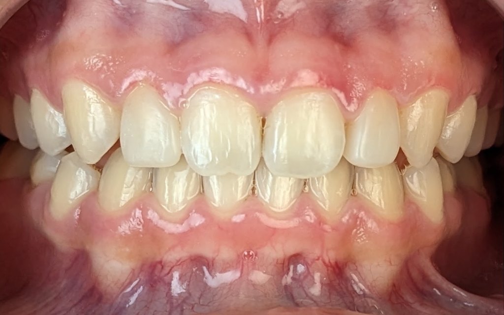 Upper front teeth after veneers, even in shape and colour