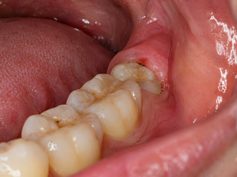 A back molar partly through the gum, with a flap of red gum over it